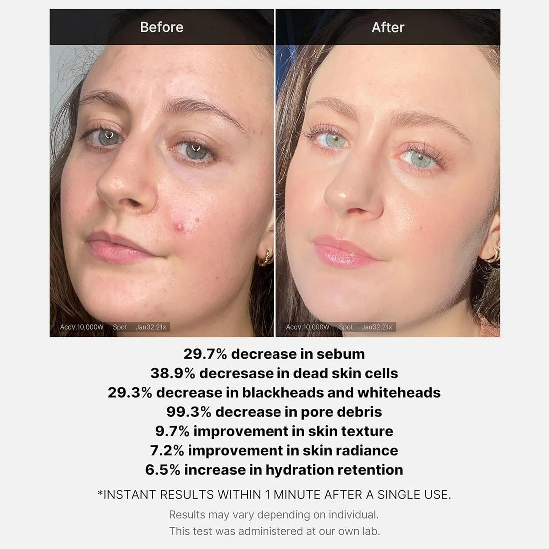 Medicube Red Acne Succinic Acid Peel | Peeling Serum 40g - Zayluxe Care