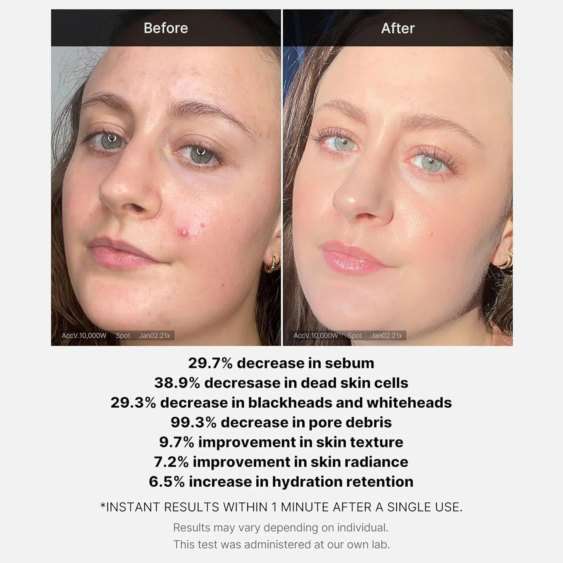 Medicube Red Acne Succinic Acid Peel | Peeling Serum 40g - Zayluxe Care