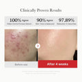 Medicube Red Acne Succinic Acid Peel | Peeling Serum 40g - Zayluxe Care